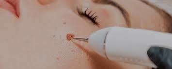 Mole Removal: Complete Guide for Safe & Effective Treatment